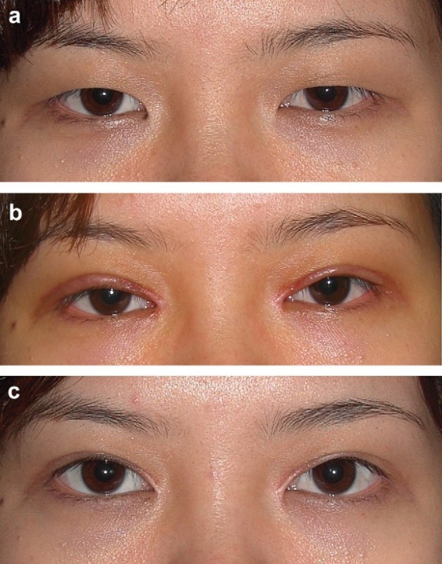 【讨论】重睑术联合改良z成形术矫正内眦赘皮!